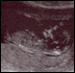 Pregnancy scans of Euan
